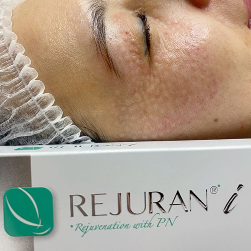 Полінуклеотиди Rejuran